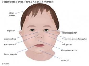 Expositie Foetaal Alcohol Syndroom (FAS) bij Trias 