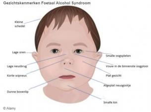 Ook incidenteel alcoholgebruik heeft effect op gezichtje van de baby